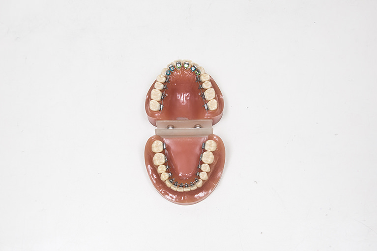 舌側矯正歯科治療について